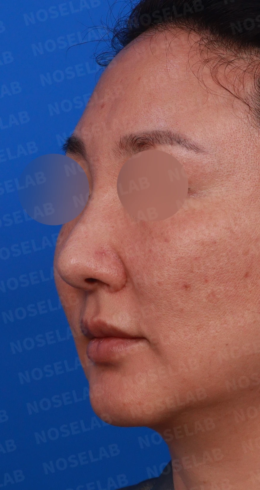 매부리 교정을 받은 코가 다시 휘어 보이는 이유와 절골 재교정 방법 — 디자인 상담 정면, 좌측 측면, 비스듬한 측면 사진