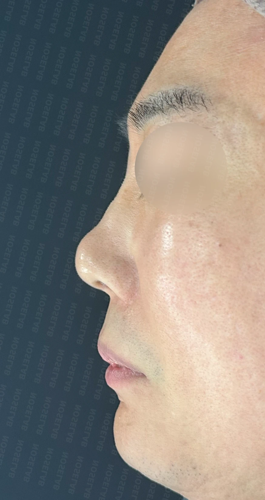 매부리코 수술 후 비대칭의 재수술 방법 — 수술 전 / 수술 직후 0일 직후 사진은 부기가 있는 상태로 최종 결과와 다를 수 있습니다.