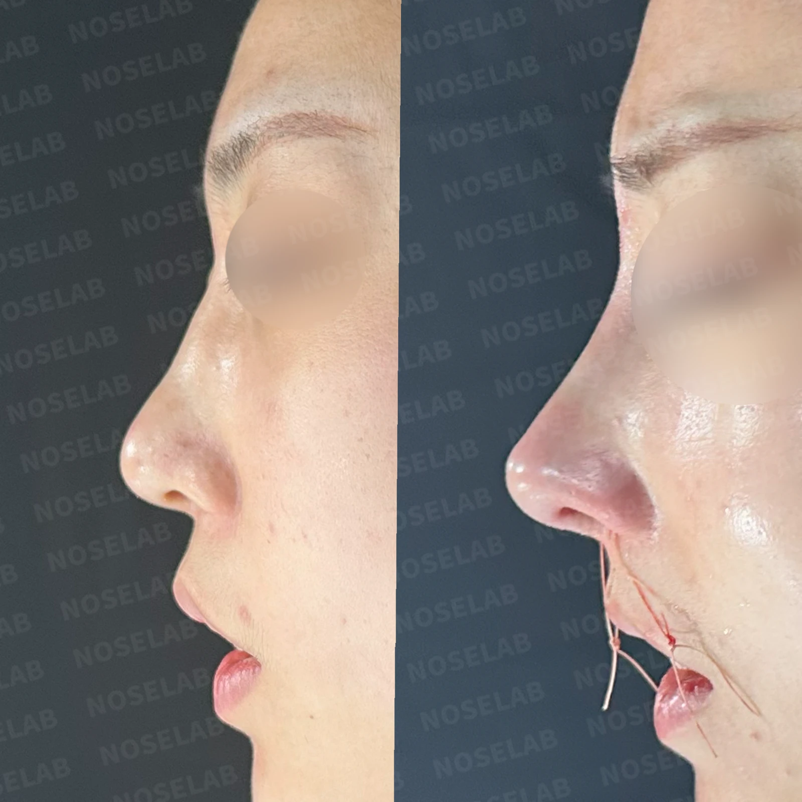 휘어진 코 교정과 비염 개선 - 자가늑연골 재건술 후기 — 본문 사진 25