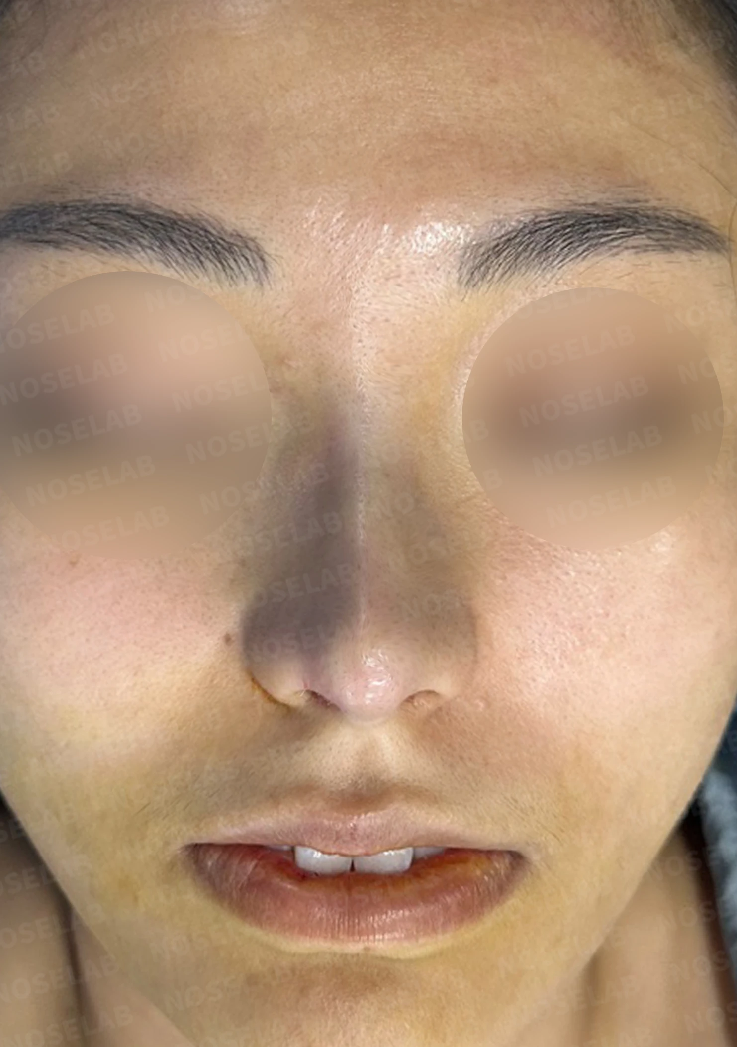 뭉툭하게 퍼진 코끝이 생기는 이유, 자가 늑연골 비중격 연장으로 직반 라인을 만드는 방법 — 수술 전 / 수술 직후 0일 직후 사진은 부기가 있는 상태로 최종 결과와 다를 수 있습니다.