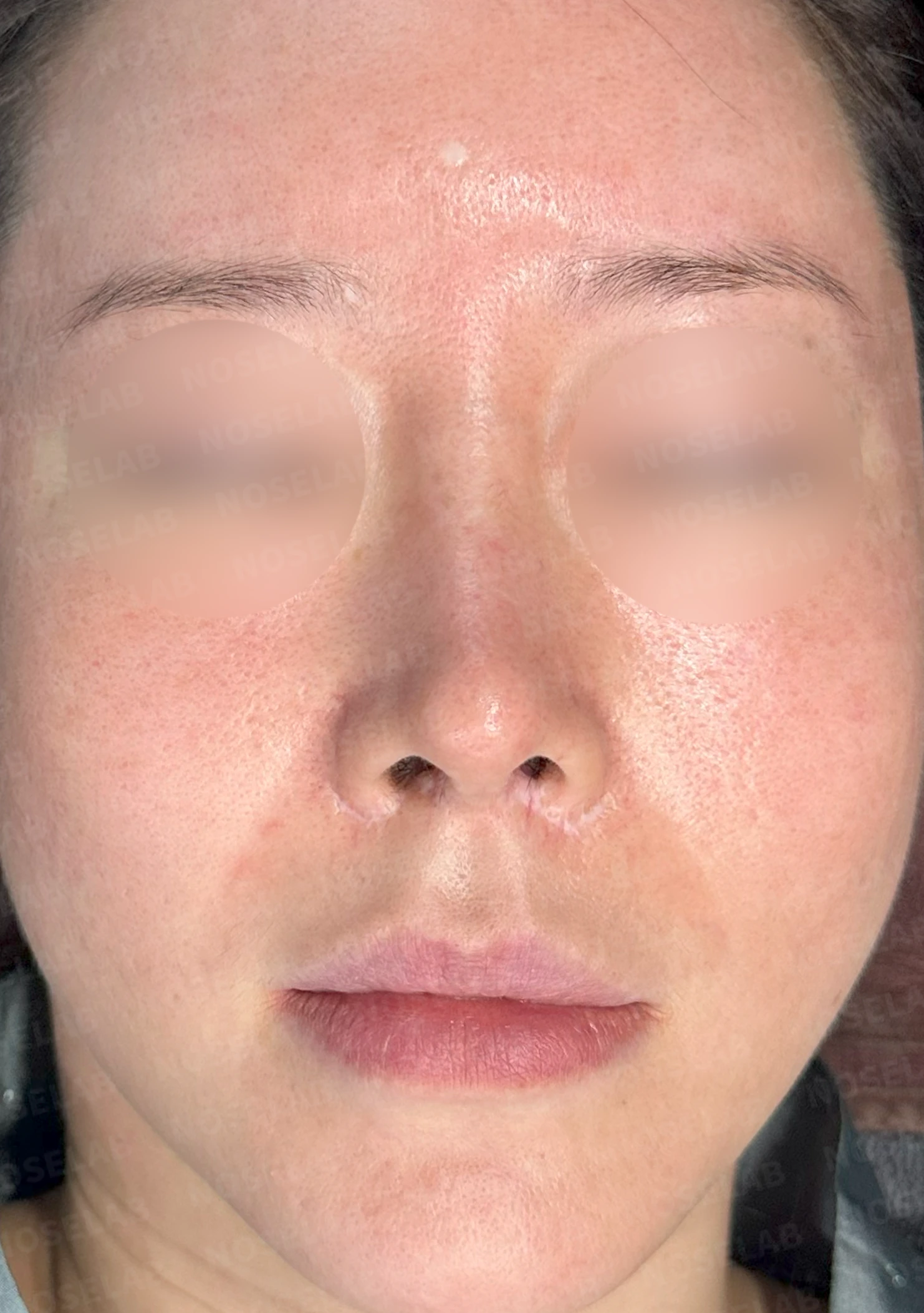 반복 수술 후 들창코와 반버선코를 교정하는 방법 — 수술 전 / 수술 직후 0일 직후 사진은 부기가 있는 상태로 최종 결과와 다를 수 있습니다.