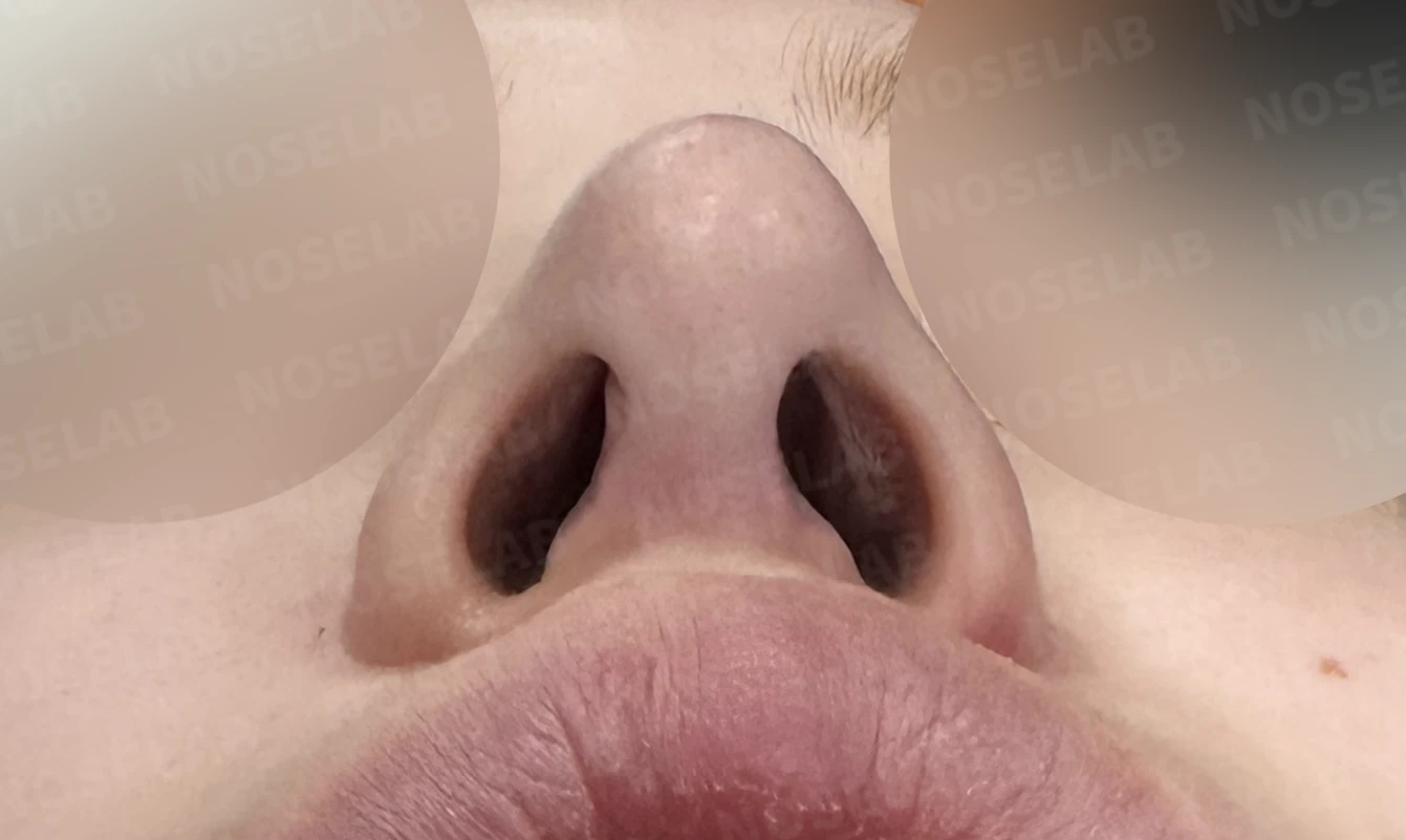 비중격이 심하게 휘고 손상되는 이유, 늑연골 재건은 어떻게 하나 — 수술 전 / 수술 직후 0일 직후 사진은 부기가 있는 상태로 최종 결과와 다를 수 있습니다.