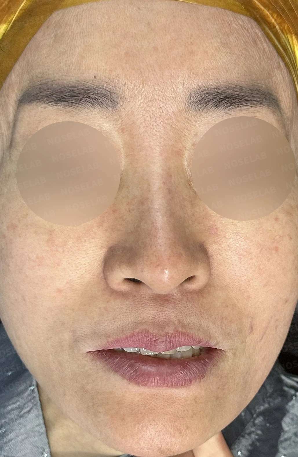 화살코, 긴코 교정 방법 — 수술 전 / 수술 직후 0일 직후 사진은 부기가 있는 상태로 최종 결과와 다를 수 있습니다.
