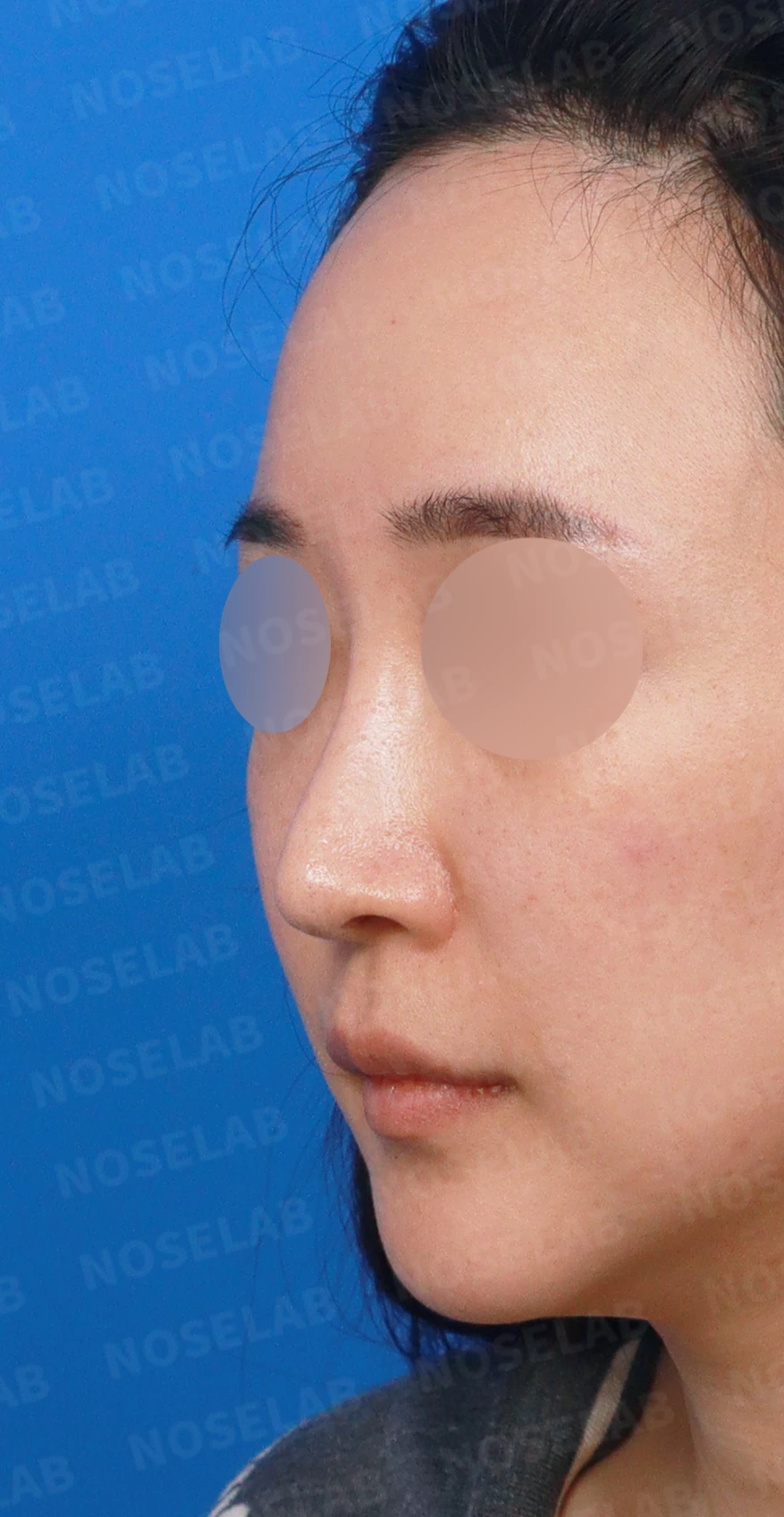 여러 번 수술한 코의 L-strut이 얇아지는 이유와 구조적 재건 방법 — 디자인 상담 정면, 좌측 측면, 비스듬한 측면 사진
