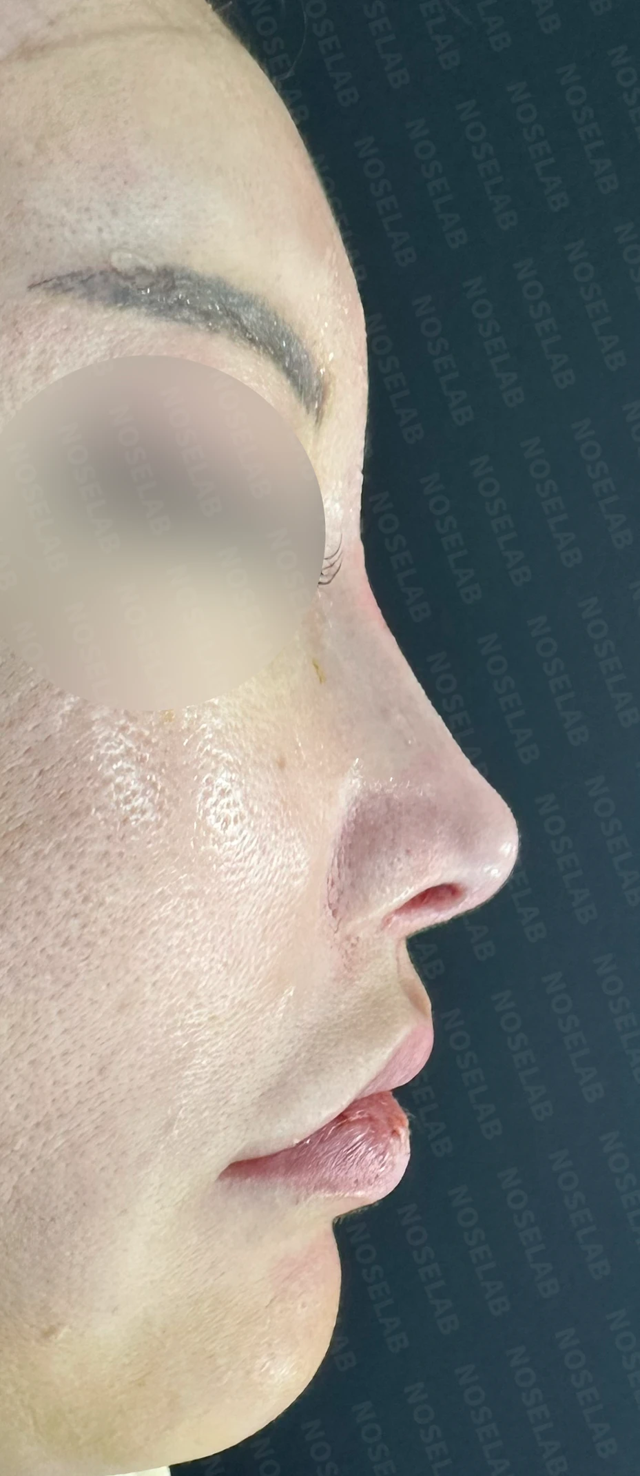 코막힘과 퍼진코 교정 방법 — 본문 사진 13