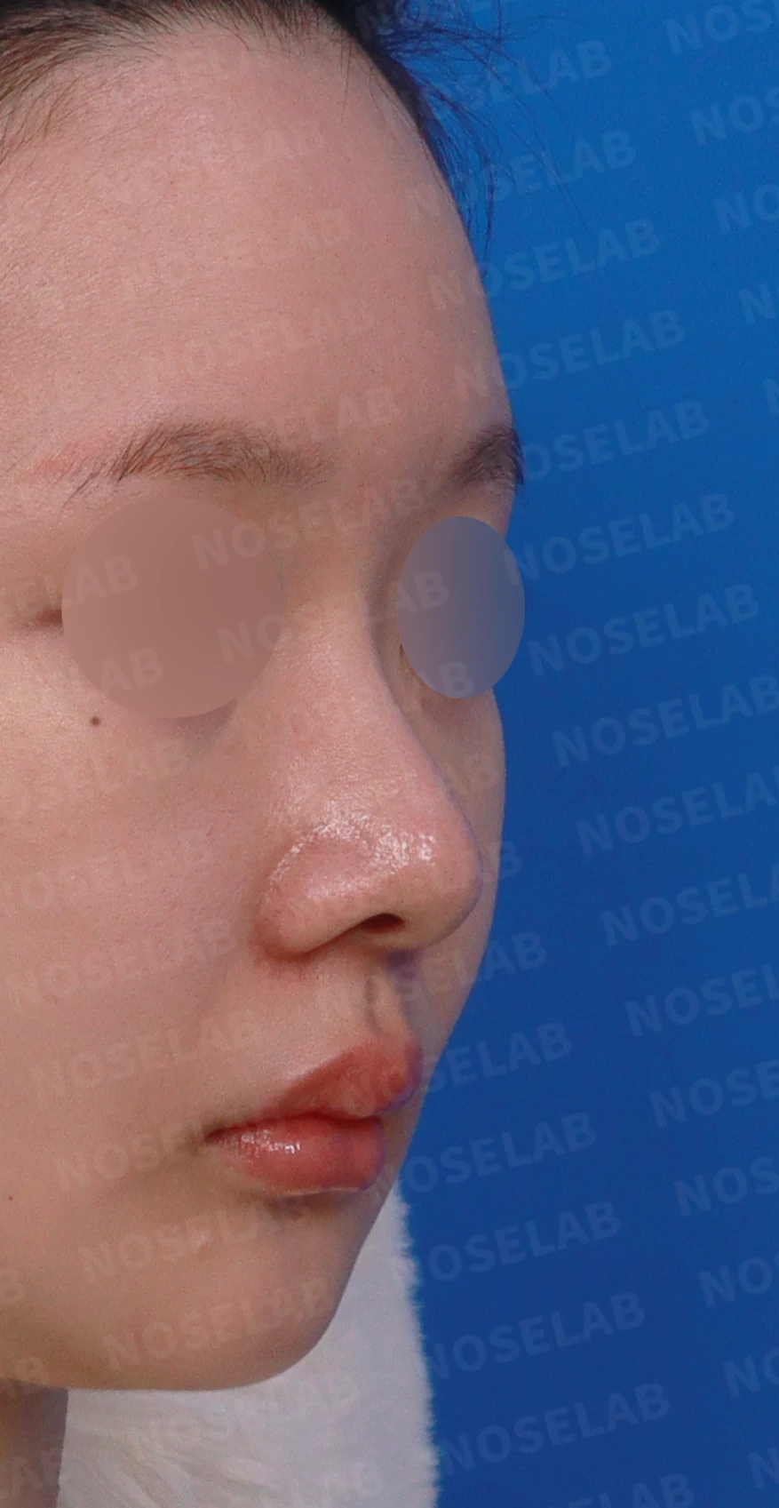 절골 부위가 과하게 깎이면 코가 왜 휘어 보이는가, 코뼈 복원과 코끝 재건 — 디자인 상담 우측 측면, 비스듬한 측면, 비공 사진입니다.