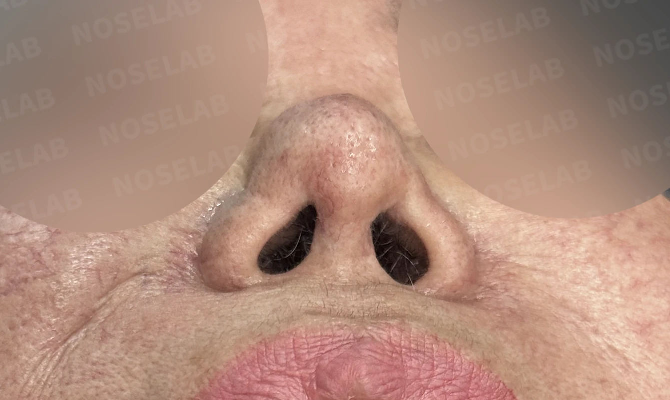 보형물 염증으로 손상된 코, 휴식기 후 기증늑연골로 안전하게 재건한 코재수술 — 전(좌) 직후(후)