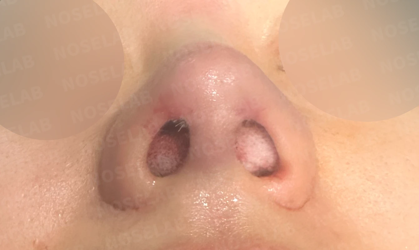 보형물을 제거한 뒤 콧대가 꺼지고 퍼지는 이유, 재건은 어떻게 하나 — 수술 전 / 수술 직후 0일 직후 사진은 부기가 있는 상태로 최종 결과와 다를 수 있습니다.