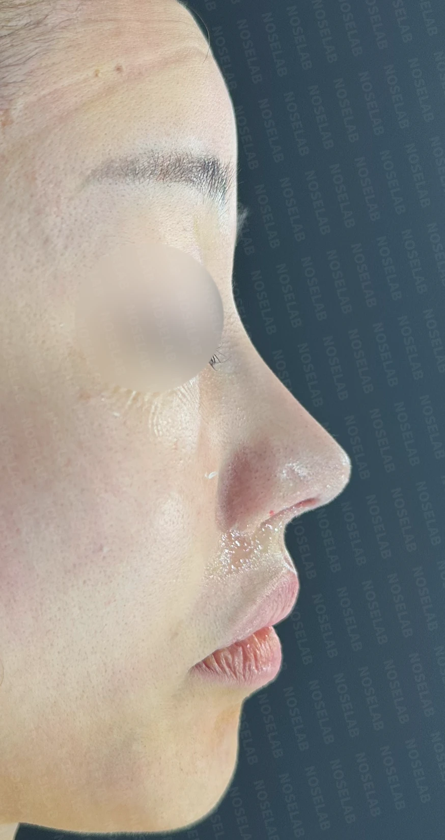 비공협착과 휜코, 코막힘을 함께 살펴보는 재수술 방법 — 수술 직후 0일 정면, 측면, 비스듬한 측면 직후 사진은 부기가 있는 상태로 최종 결과와 다를 수 있습니다.