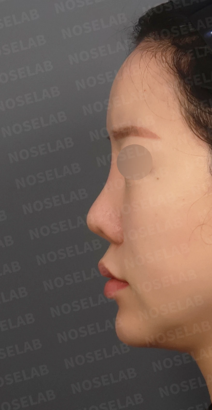짧은 코와 복코, 자가늑연골로 세련되게 교정한 코재수술 — 디자인 상담 정면, 좌측 측면, 비스듬한 측면 사진입니다.