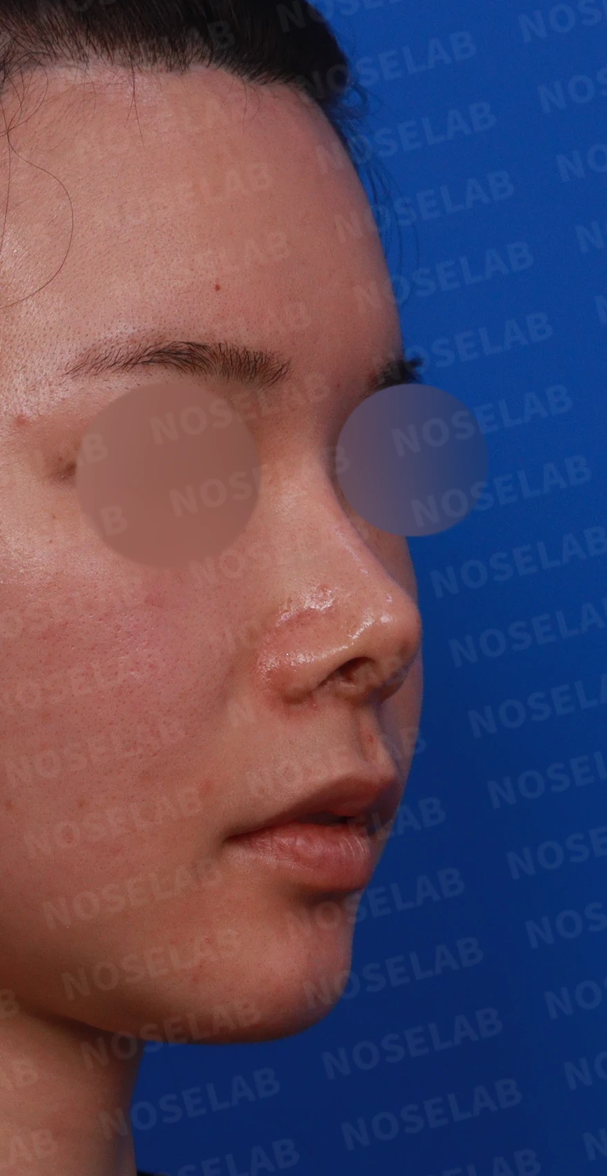 코끝 피부 상태와 괴사 위험을 고려한 재수술 계획 — 수술전 디자인 상담 정면, 측면, 비스듬한 측면 [들린코, 퍼진코, 휜코]