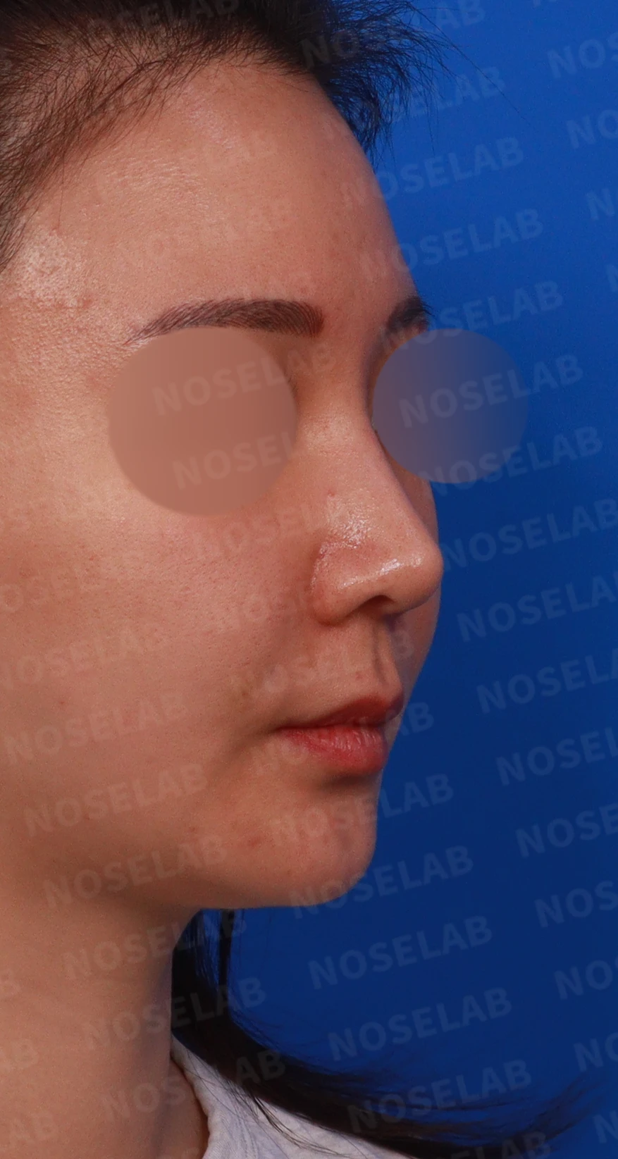 코가 휘어 보이고 비주가 한쪽으로 기우는 이유, 교정은 어떻게 하나 — 디자인 상담 우측 측면, 비스듬한 측면 비공 사진