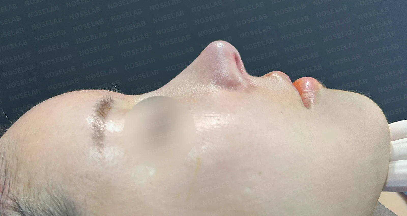 다섯 번의 수술 끝에 찾은 완벽한 코: 들린코와 휜코의 극적인 변신 — 수술전(좌) 수술직후(우)