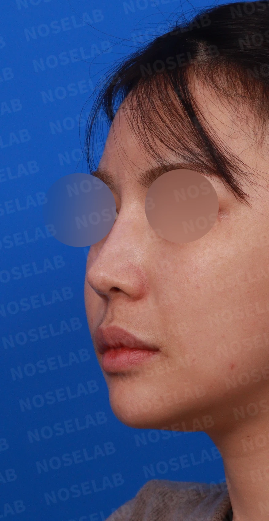 고양이 보형물 제거와 자연스러운 코 재건 - 휘어진 코성형 후기 — 디자인 상담 정면, 좌측 측면, 비스듬한 측면 사진