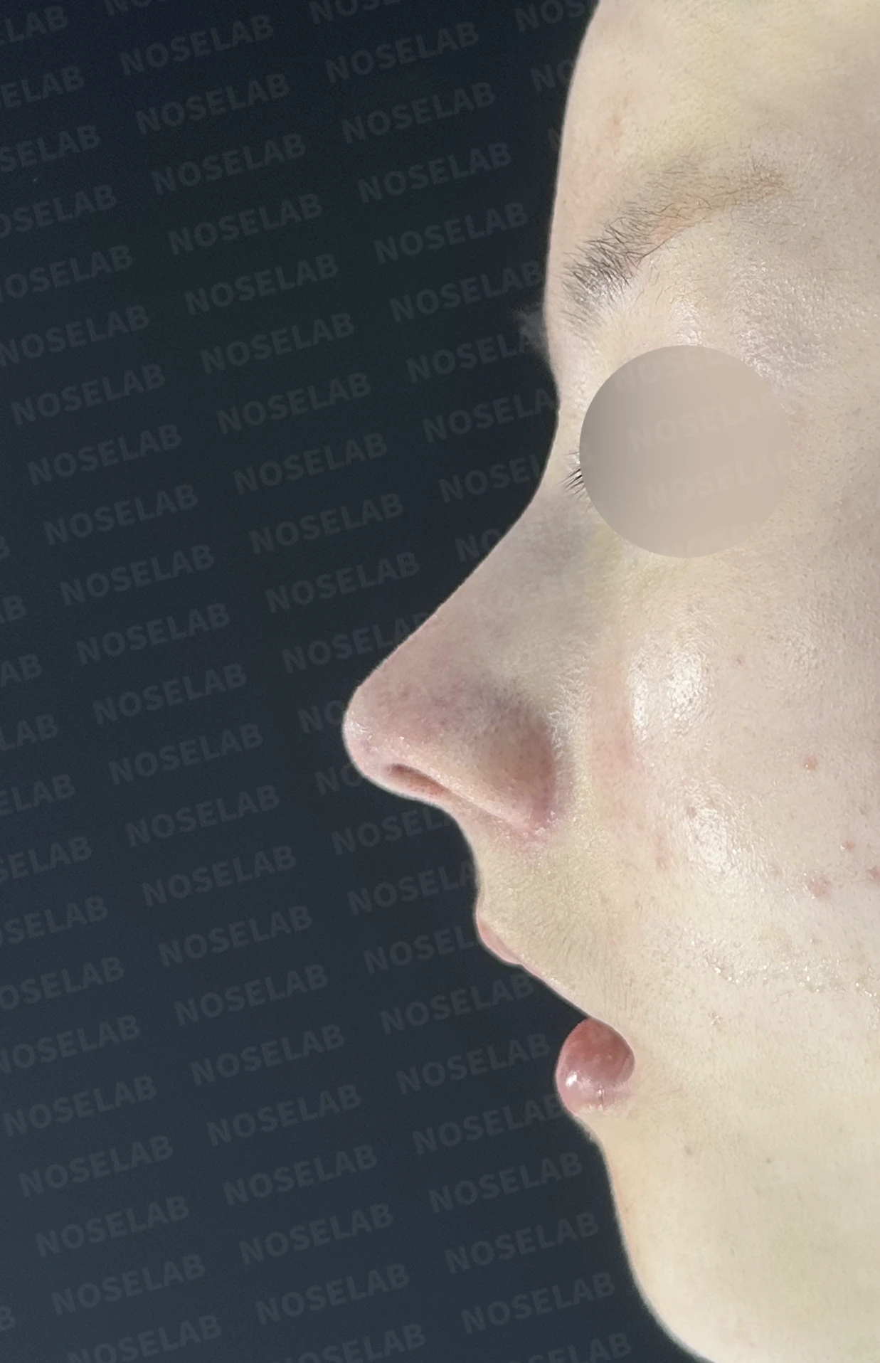 콧대가 퍼져 보이고 코끝이 뭉툭한 이유, 절골술과 자가 늑연골 교정은 어떻게 하나 — 수술 직후 0일 정면, 비스듬한 측면, 측면 사진입니다. 직후 사진은 부기가 있는 상태로 최종 결과와 다를 수 있습니다.