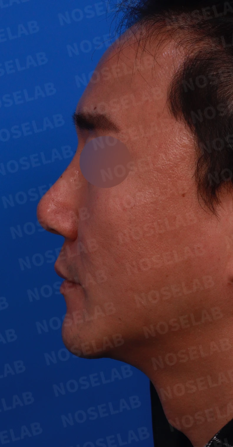 휜코와 코막힘, 코끝 구조를 함께 교정하는 방법 — 디자인 상담 정며, 좌측 측면, 비스듬한 측면 사진입니다.