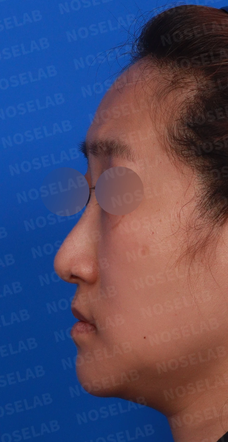 코가 한쪽으로 휘어 보이고 밤에 막히는 이유, 비중격 재건과 코막힘 개선 — 디자인 상담 정면 , 좌측 비스듬한 측면 , 측면 사진입니다.
