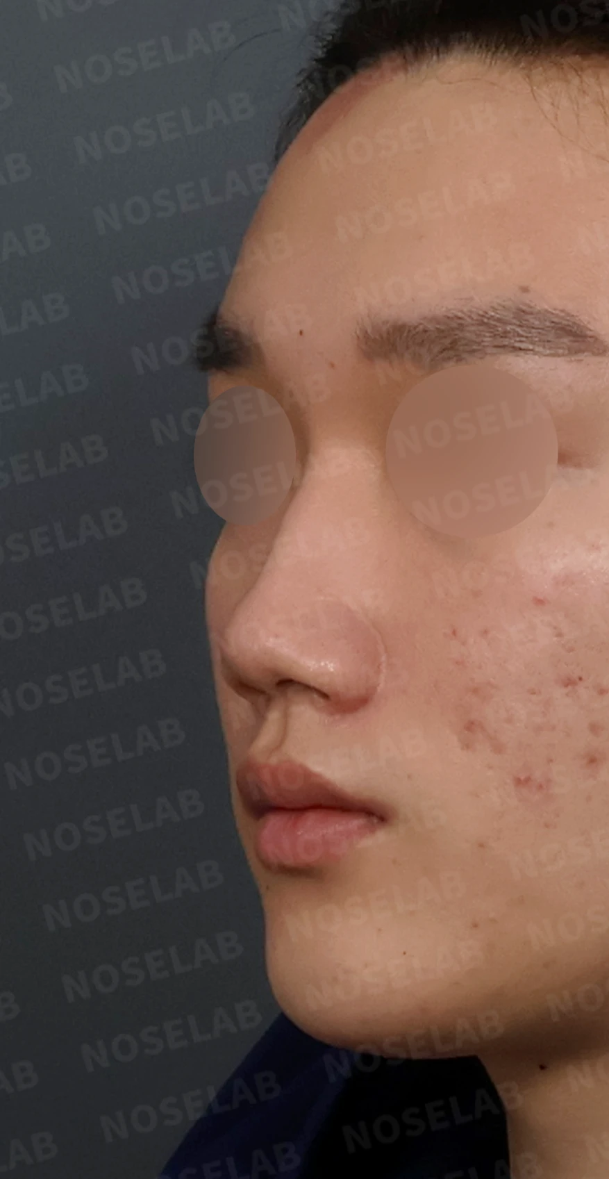 휜코 매부리코 교정, 남자 코성형으로 자연스러운 변화 — 디자인 상담 정면, 좌측 측면, 비스듬한 측면 사진입니다.