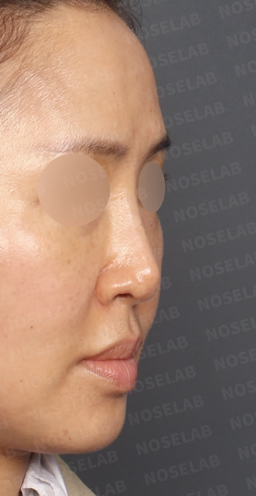 보형물 비침과 용코, 자가늑연골로 안전하게 교정한 코재수술 — 디자인 상담 우측 측면, 비스듬한 측면, 비공 사진입니다.