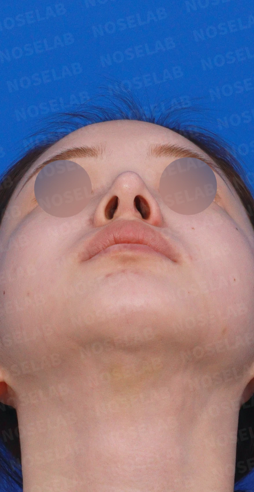 비중격이 심하게 휘고 손상되는 이유, 늑연골 재건은 어떻게 하나 — 디자인 상담 우측 측면, 비스듬한 측면, 비공 사진입니다.