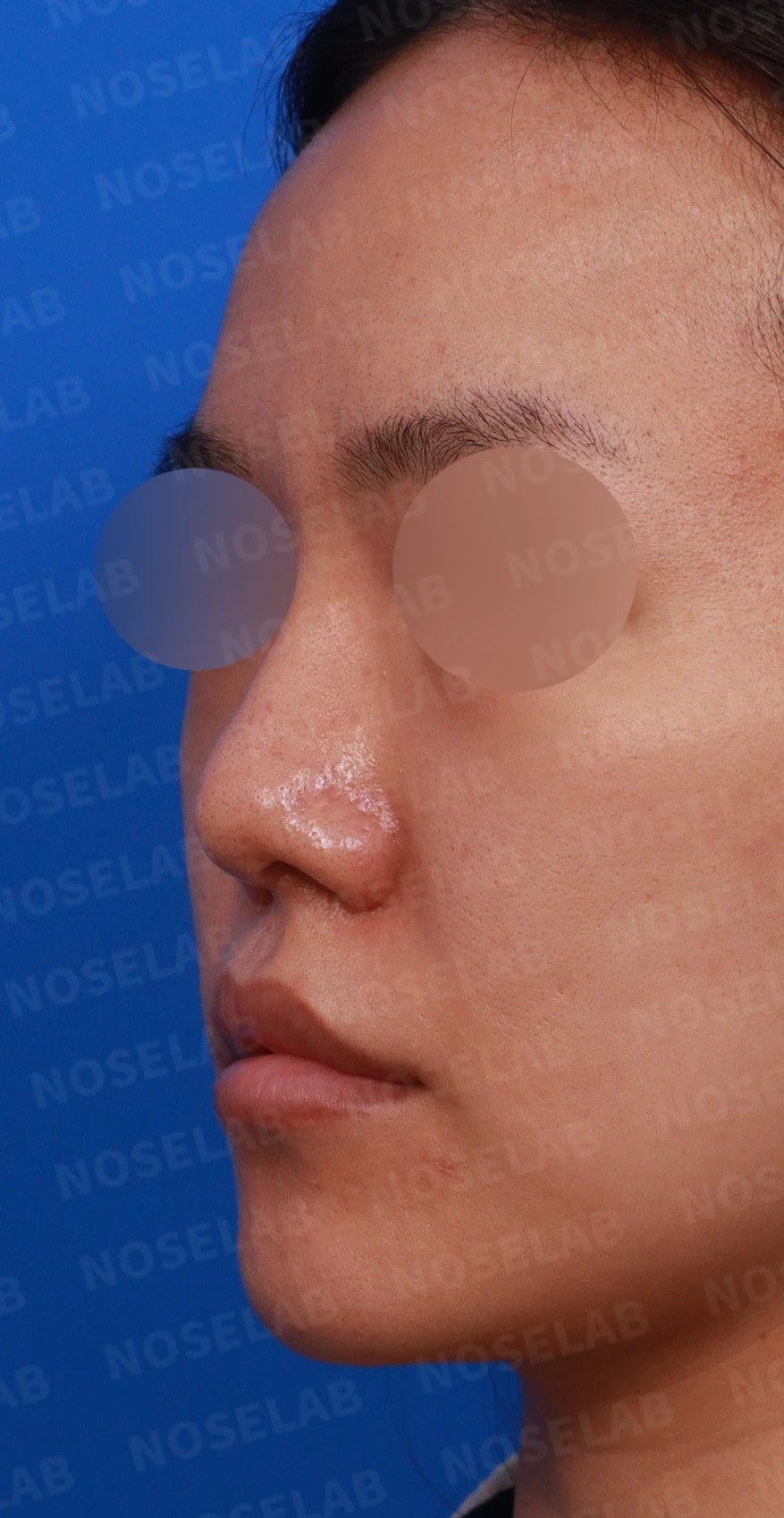 구순구개열에 동반된 코 변형의 교정 방법 — 디자인 상담 사진입니다. 정면, 좌측 비스듬한 측면, 측면