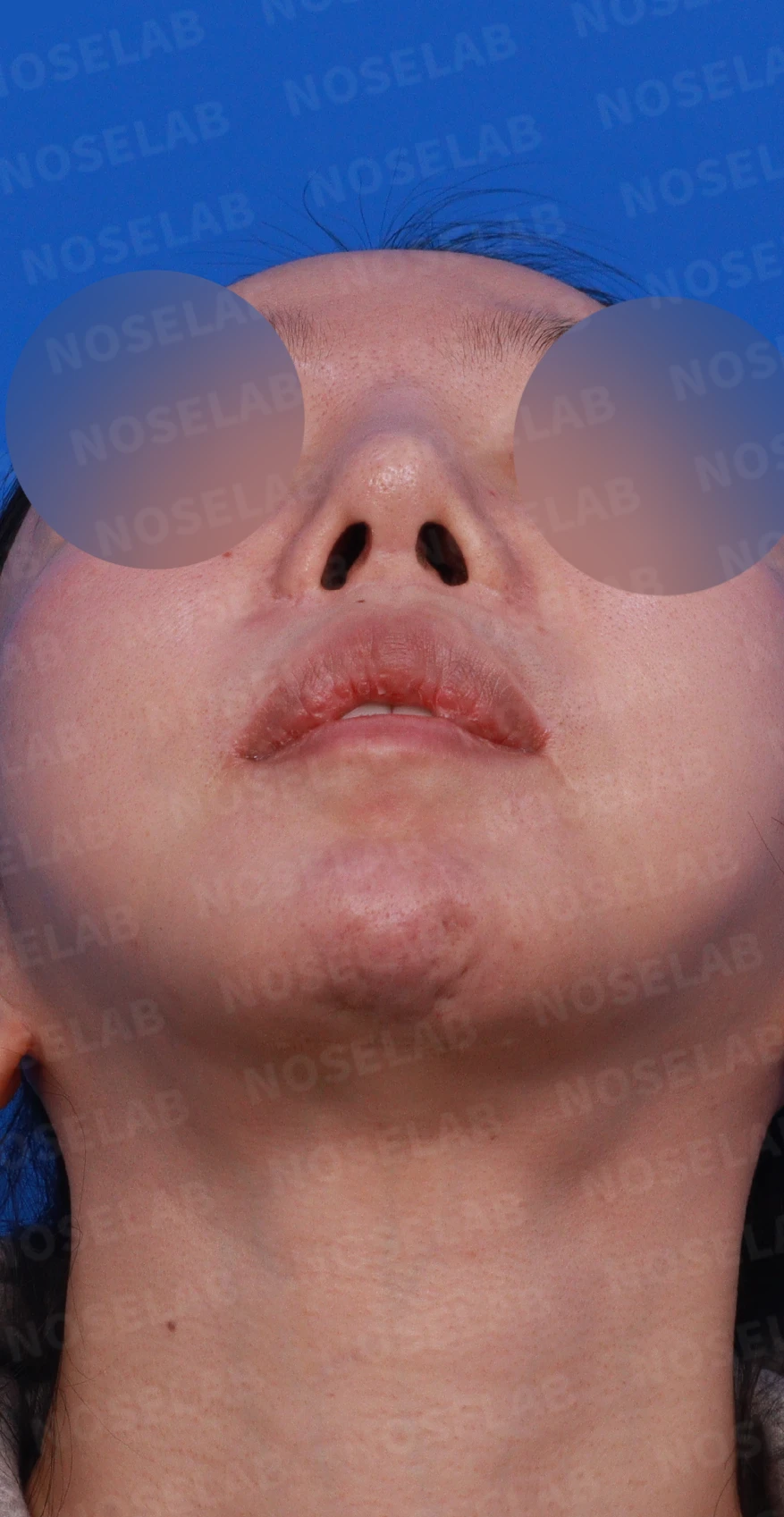 콧대가 뭉툭하게 퍼져 보이는 만성 이물 반응, 원인과 재건 방법 — 디자인 상담 우측 비스듬한 측면, 측면, 비공 사진