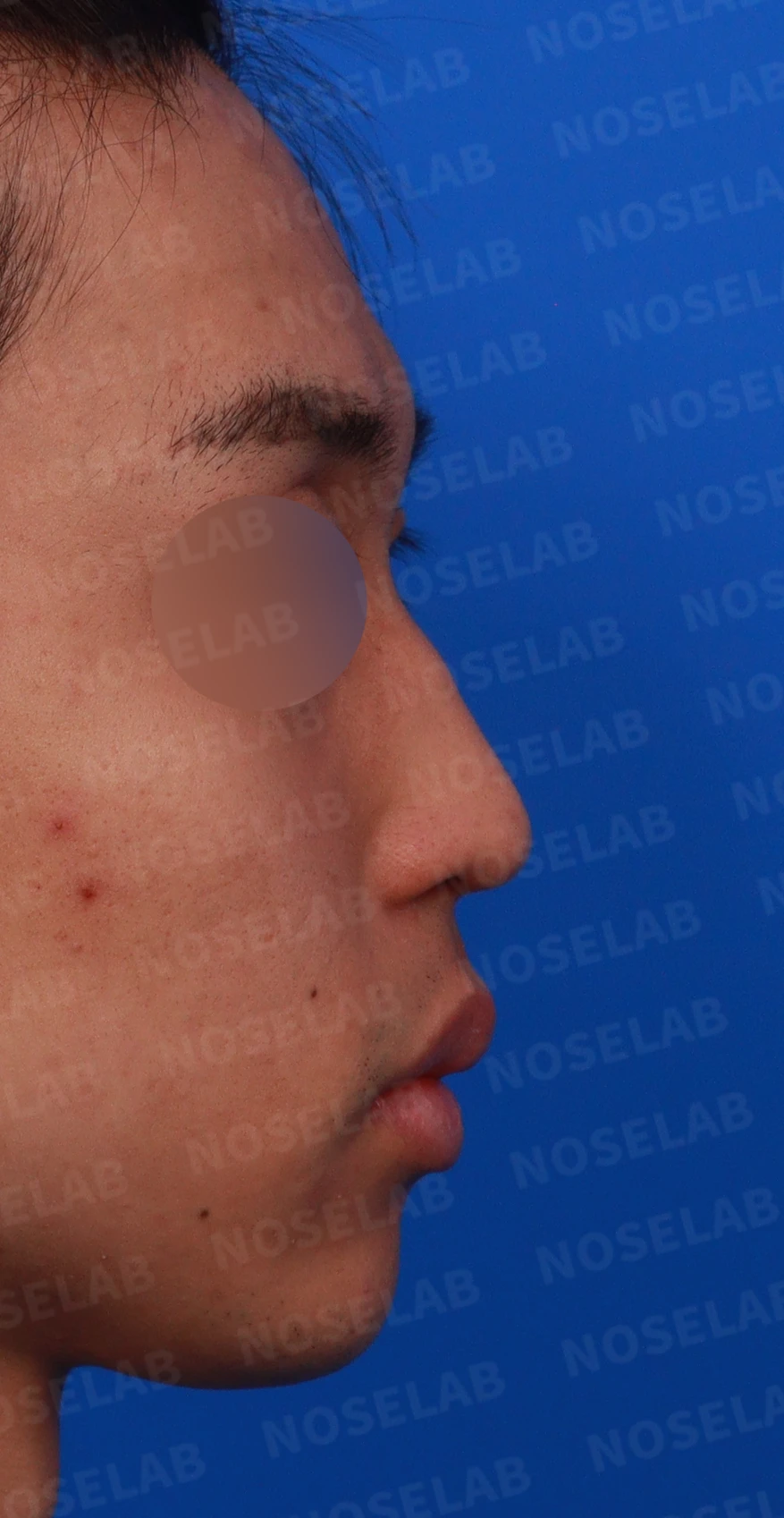 비염 수술 뒤에도 증상이 재발하는 이유, 휜 코를 함께 교정하는 방법 — 디자인 상담 우측 비스듬한 측면, 측면, 비공 사진