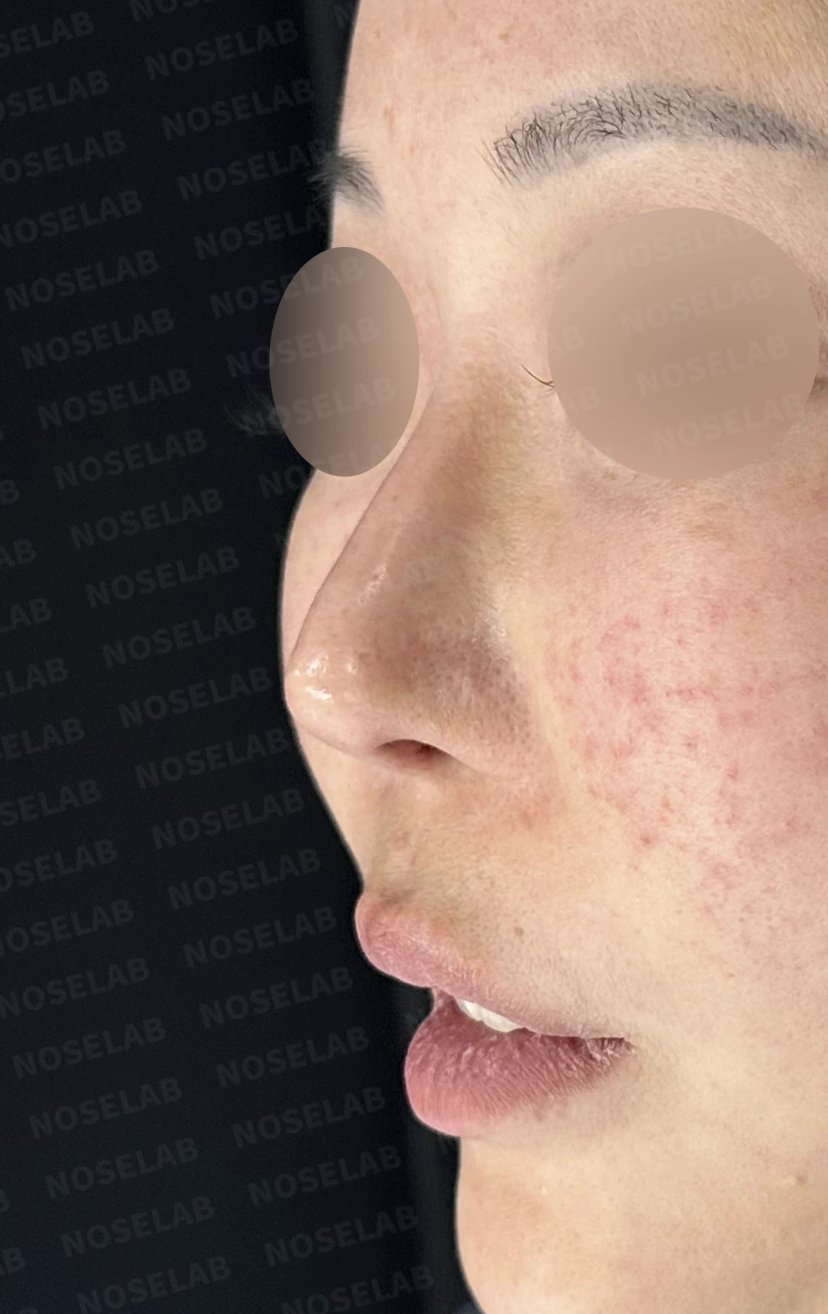 코성형 뒤 코막힘이 더 심해지는 이유, 비중격 재건과 절골 복원은 어떻게 하나 — 수술 전 / 수술 직후 0일 직후 사진은 부기가 있는 상태로 최종 결과와 다를 수 있습니다.