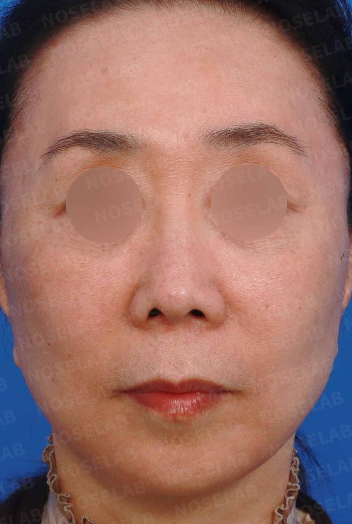 정면에서 콧구멍이 한쪽만 더 보이는 이유와 코끝 재건 방법 — 디자인 상담 정면, 좌측 측면, 비스듬한 측면 사진입니다.