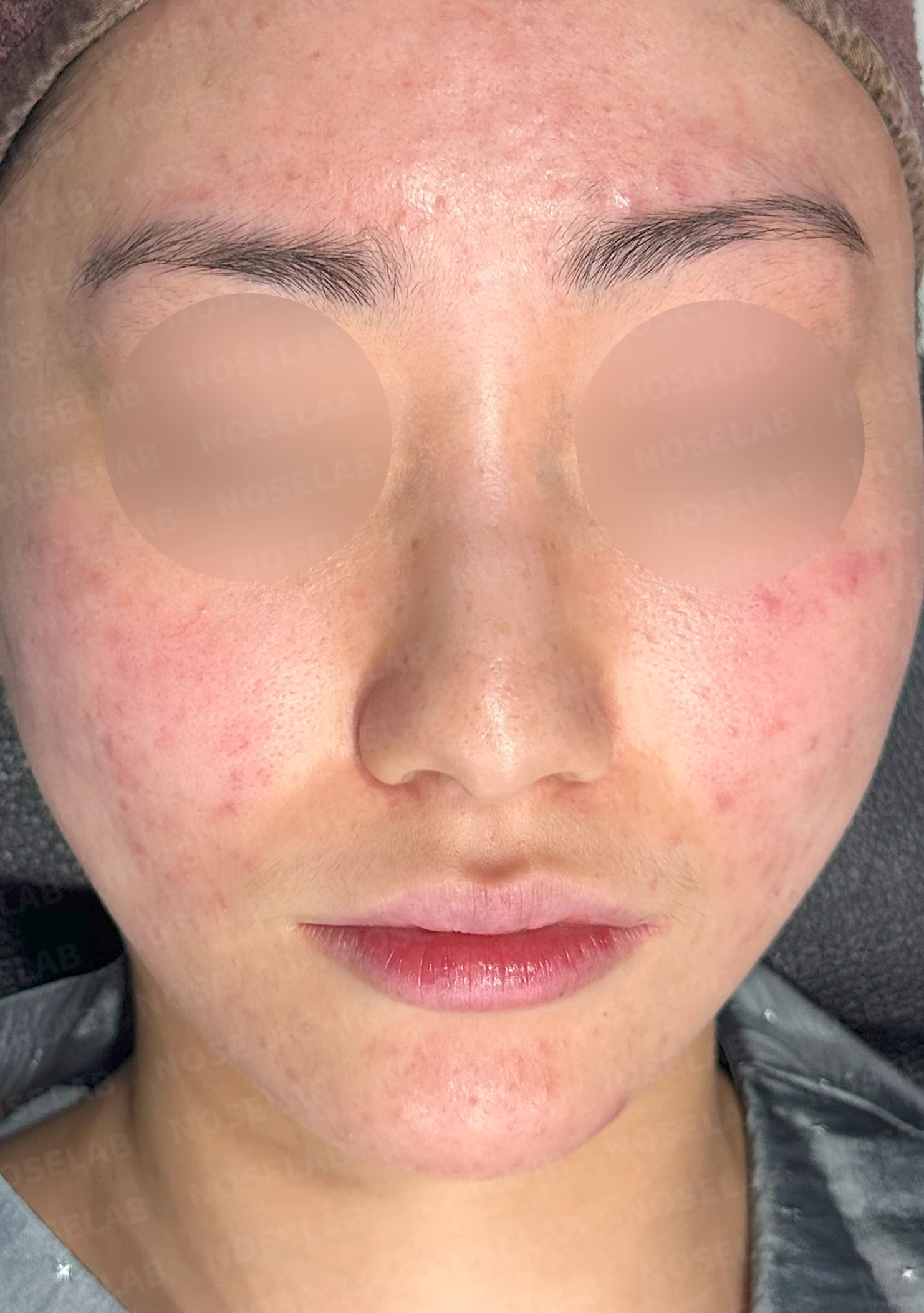 코끝이 뭉툭하게 퍼지고 코가 휘어 보이는 이유, 늑연골 재건은 어떻게 하나 — 수술 전 / 수술 직후 0일 직후 사진은 부기가 있는 상태로 최종 결과와 다를 수 있습니다.
