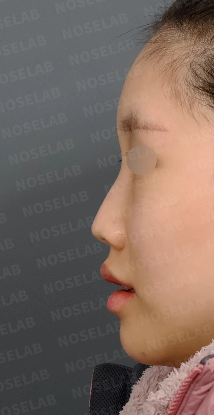 무보형물 코성형, 휘어진 콧대와 처진 코끝을 자연스럽게 교정 — 디자인 상담 정면, 좌측 측면, 비스듬한 측면 사진입니다.