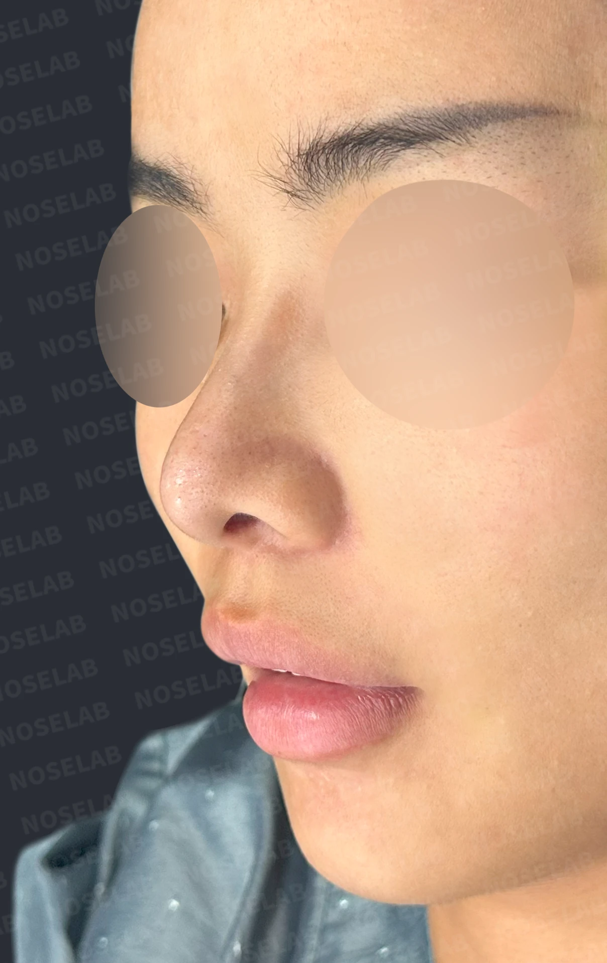 코성형 뒤 코끝이 처지고 웃을 때 퍼지는 이유, 이물질 제거와 코끝 교정 방법 — 수술 전 / 수술 직후 0일 직후 사진은 부기가 있는 상태로 최종 결과와 다를 수 있습니다.