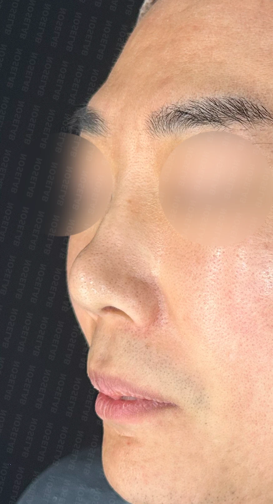 매부리코 수술 후 비대칭의 재수술 방법 — 수술 전 / 수술 직후 0일 직후 사진은 부기가 있는 상태로 최종 결과와 다를 수 있습니다.