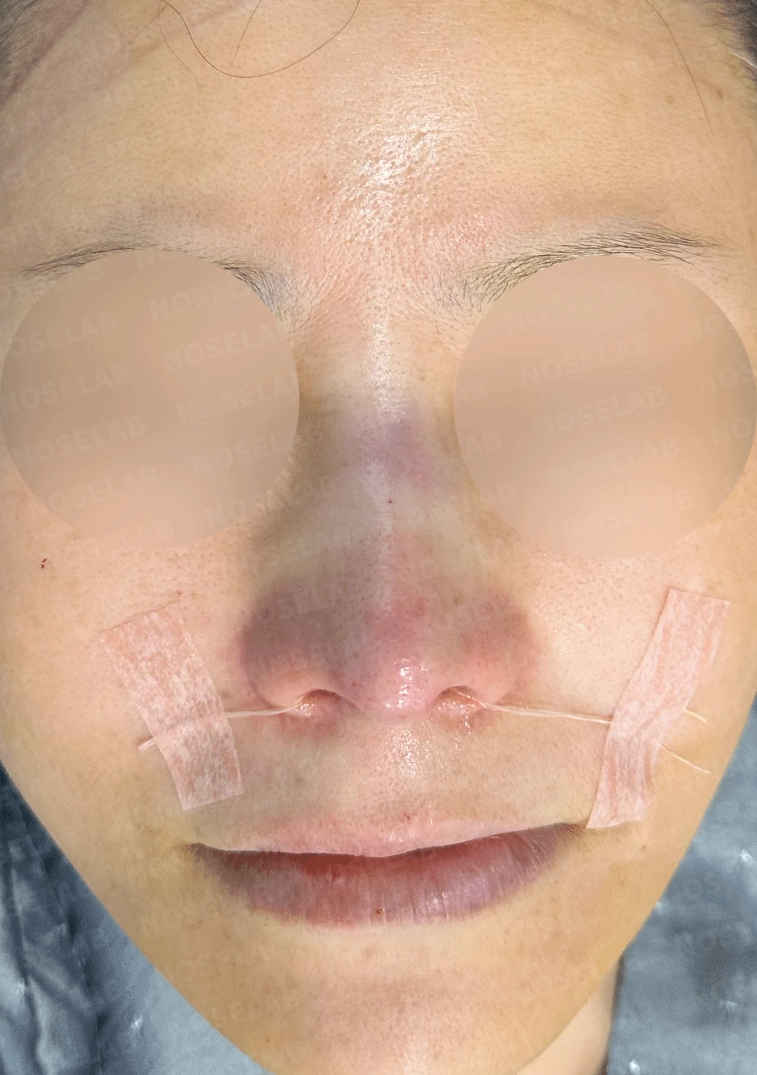 오래된 실리콘이 코끝에서 비쳐 보이는 이유와 제거·재건 방법 — 본문 사진 8