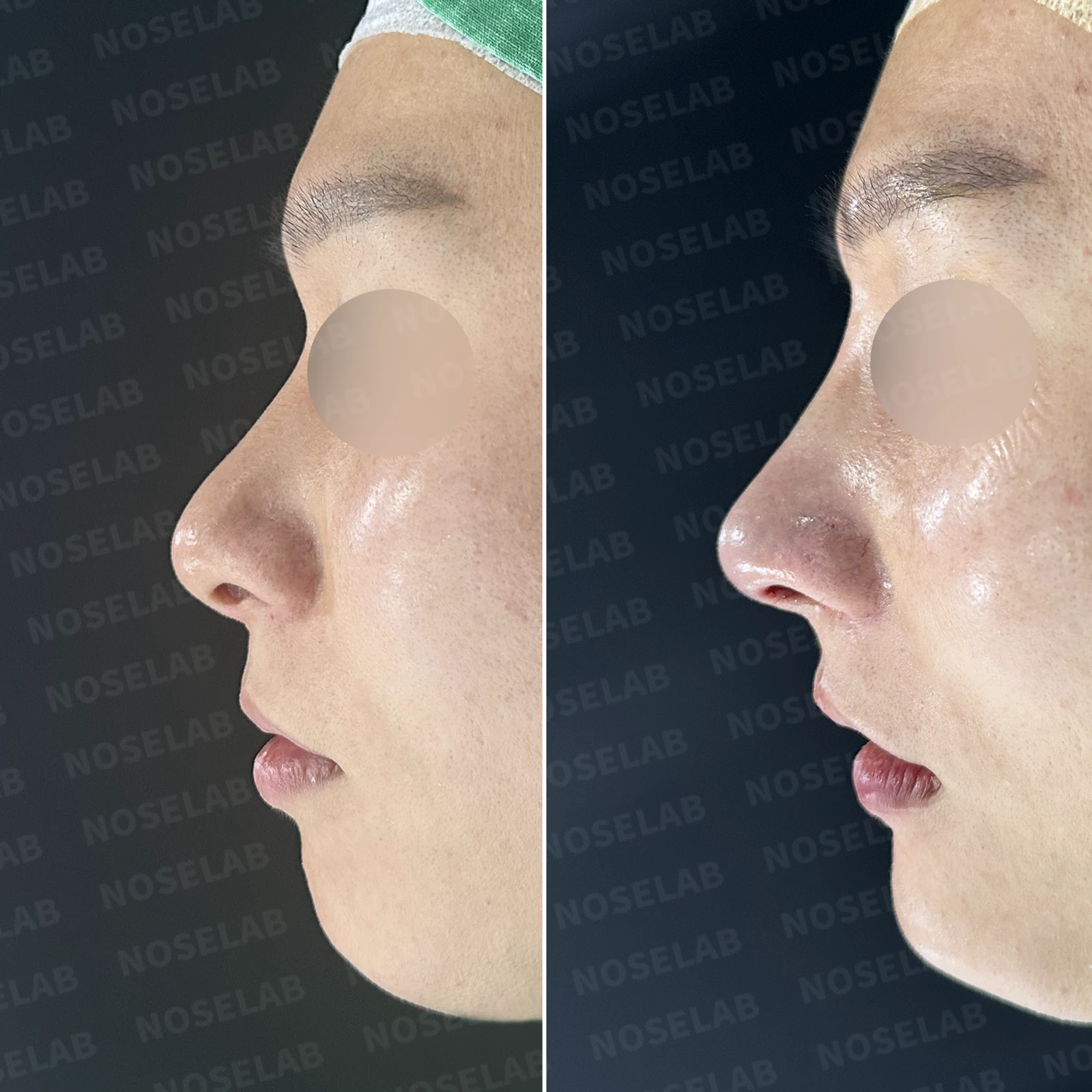 한쪽 비골이 함몰되면 왜 코가 휘어 보이는가, 절골 복원과 비중격 재건 — 본문 사진 20