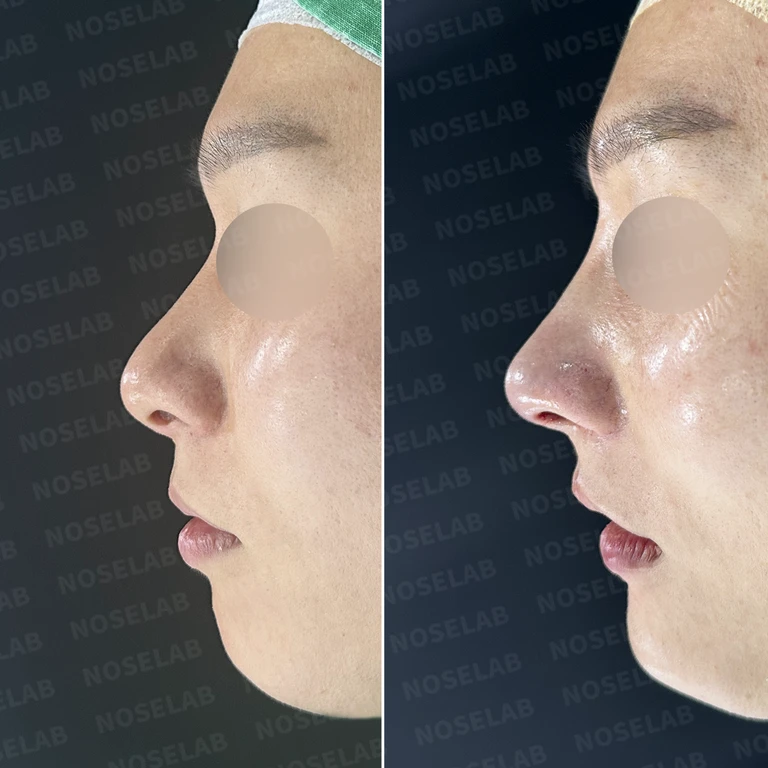한쪽 비골이 함몰되면 왜 코가 휘어 보이는가, 절골 복원과 비중격 재건 — 전후 비교