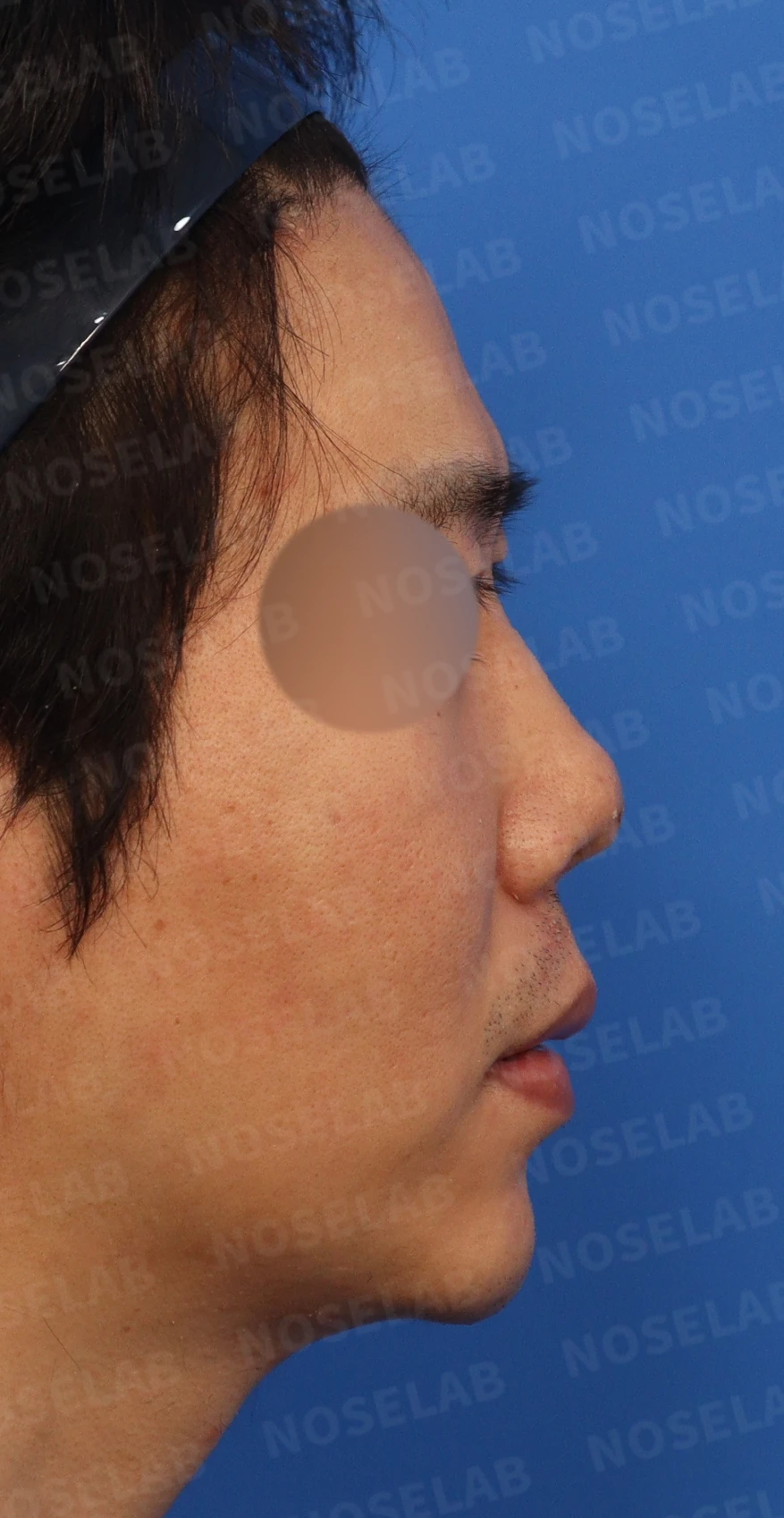 코끝 염증을 겪은 뒤 콧날개가 찝히고 코끝이 꺼지는 이유와 재건 방법 — 디자인 상담 우측 비스듬한 측면, 측면, 비공 사진