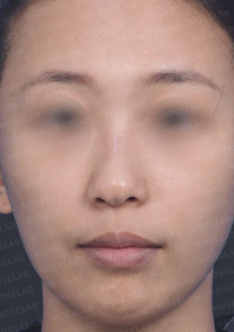 갈라져 보이는 코끝의 구조와 교정 방법 — 수술 전 / 수술 직후 0일 직후 사진은 부기가 있는 상태로 최종 결과와 다를 수 있습니다.