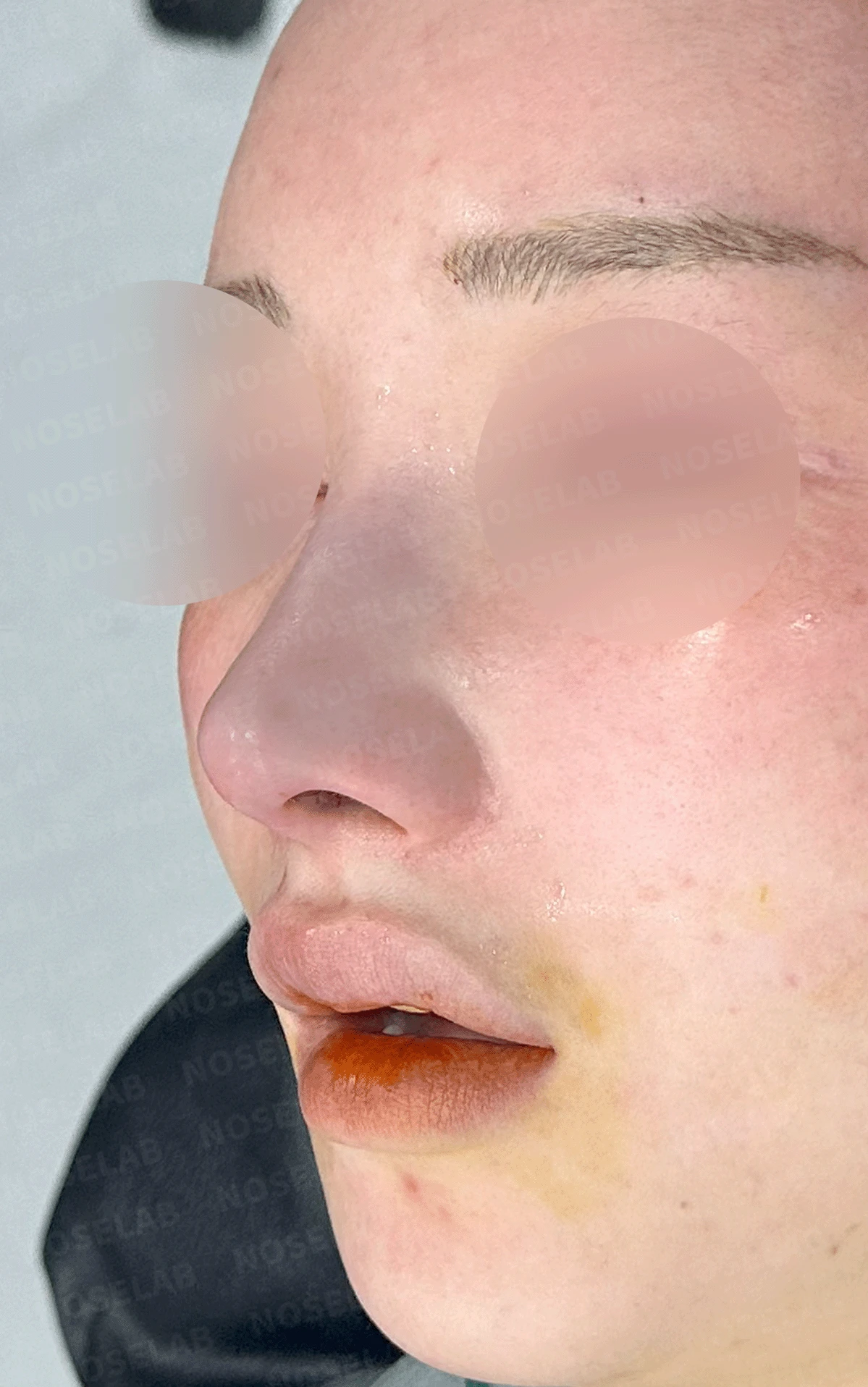 진피 이식 후 울퉁불퉁해진 콧대, 원인과 무보형물 재건 방법 — 수술 직후 0일 정면 , 측면 , 비스듬한 측면 사진입니다. 직후 사진은 부기가 있는 상태로 최종 결과와 다를 수 있습니다.