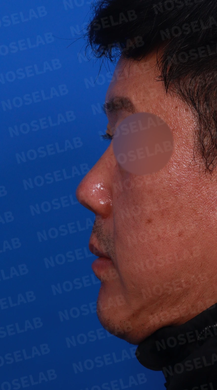 짧고 들린 코의 구조와 교정 방법 — 디자인 상담 정면, 좌측 측면, 비스듬한 측면 사진입니다.