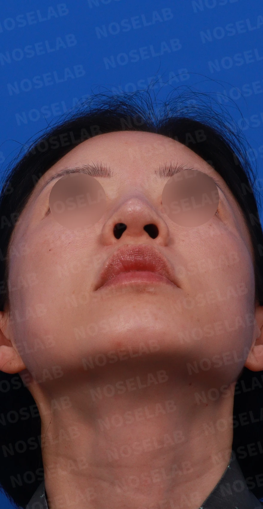 충격을 받은 뒤 코끝에서 소리가 나고 모양이 달라지는 이유와 늑연골 재건 — 디자인 상담 우측 측면 , 비스듬한 측면 , 비공 사진입니다.