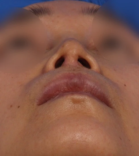 인중축소술 교정과 자가진피 제거 가능한가요? — 본문 사진 3
