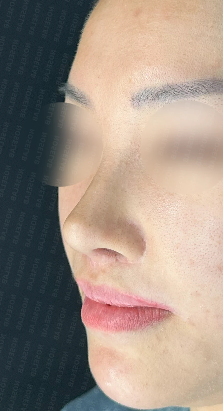 원하는 코 모양과 현재 구조를 함께 살펴보는 수술 계획 — 수술 전 / 수술 직후 0일 직후 사진은 부기가 있는 상태로 최종 결과와 다를 수 있습니다.