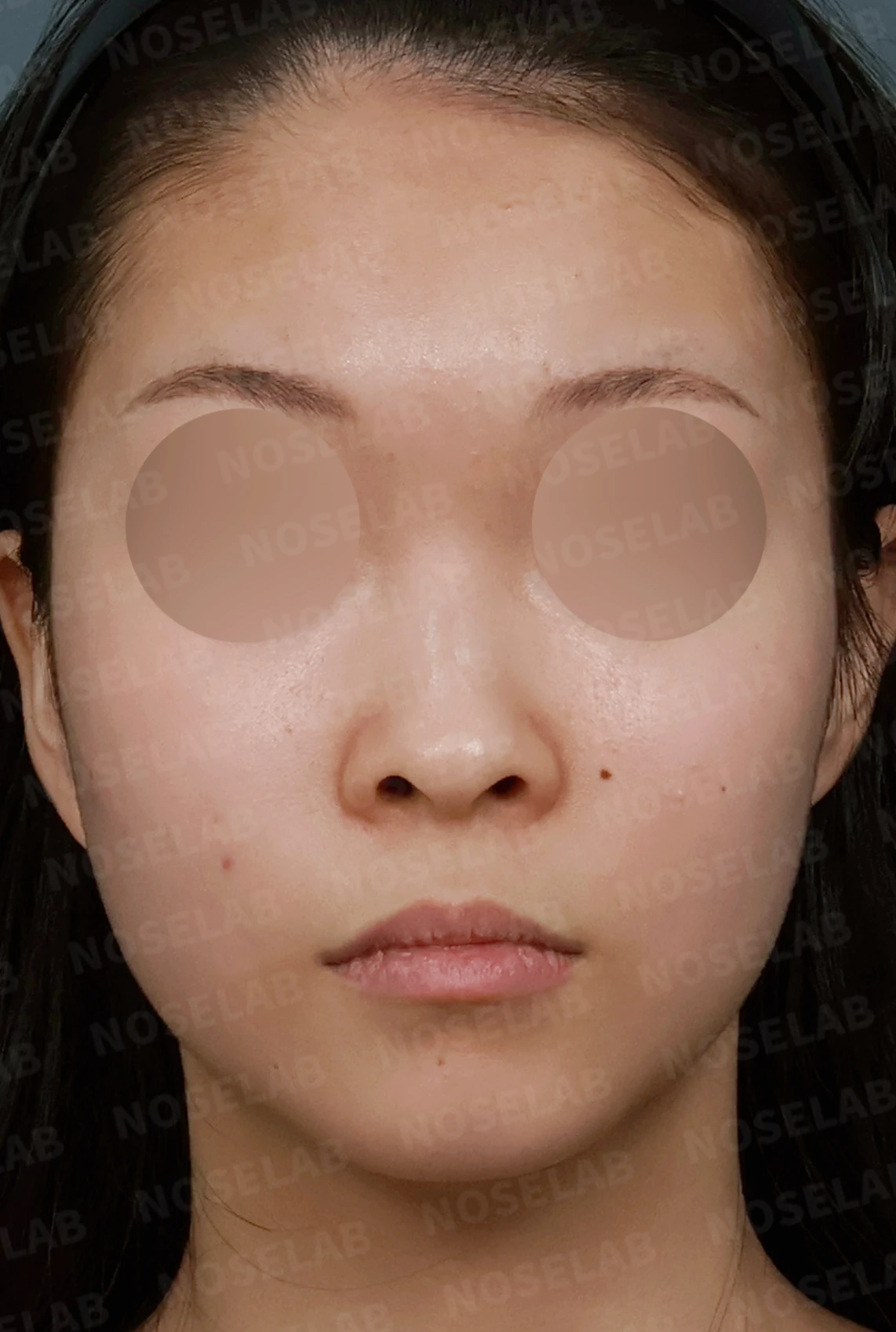 낮고 퍼진 코, 기증늑연골과 실리콘 보형물로 자연스러운 코 라인 완성 — 디자인 상담 정면, 좌측 측면, 비스듬한 측면 사진입니다.