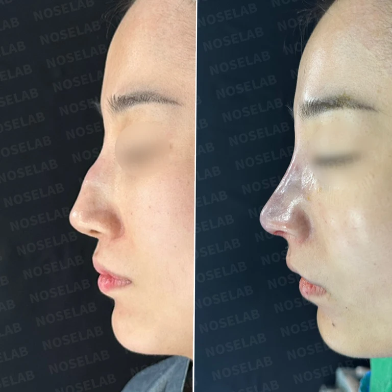 메드포어 점막 돌출로 인한 염증 코 - 자가늑연골 재건 수술 후기 — 전후 비교