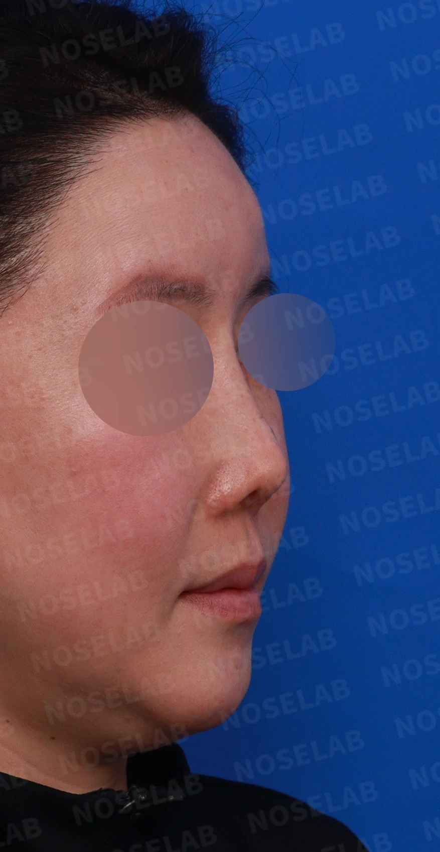 귀족수술 보형물이 코 안으로 밀려 나와 숨이 막히는 이유와 재건 방법 — 디자인 상담 우측 비스듬한 측면, 측면, 비공 사진입니다.