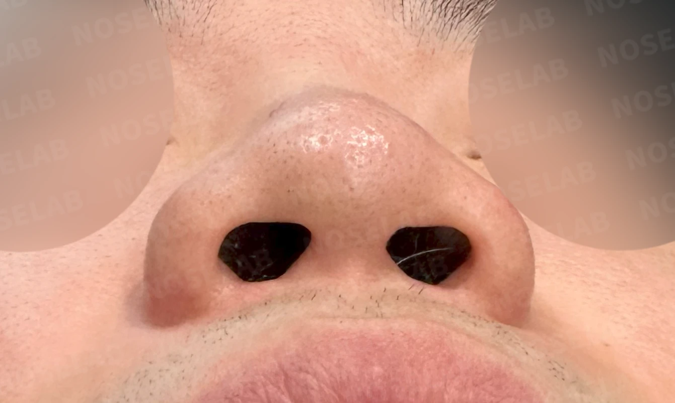 복코와 퍼진 코의 코성형 방법 — 수술 전 / 수술 직후 0일 직후 사진은 부기가 있는 상태로 최종 결과와 다를 수 있습니다.