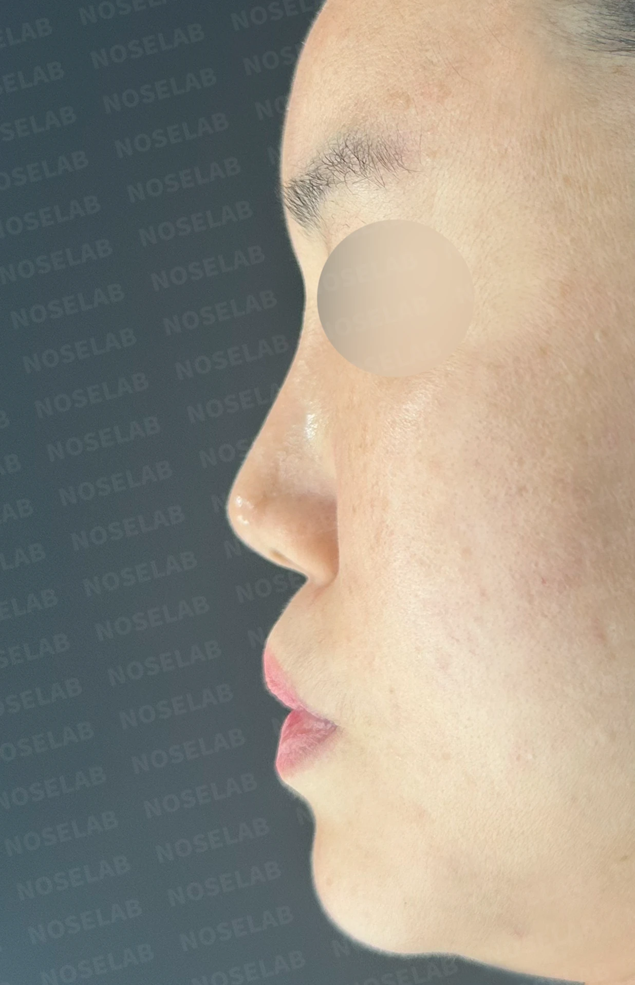 메드포어를 넣은 코에 코막힘이 생기는 이유, 제거와 자가늑연골 비중격 재건은 어떻게 하나 — 수술 전 / 수술 직후 0일 직후 사진은 부기가 있는 상태로 최종 결과와 다를 수 있습니다.