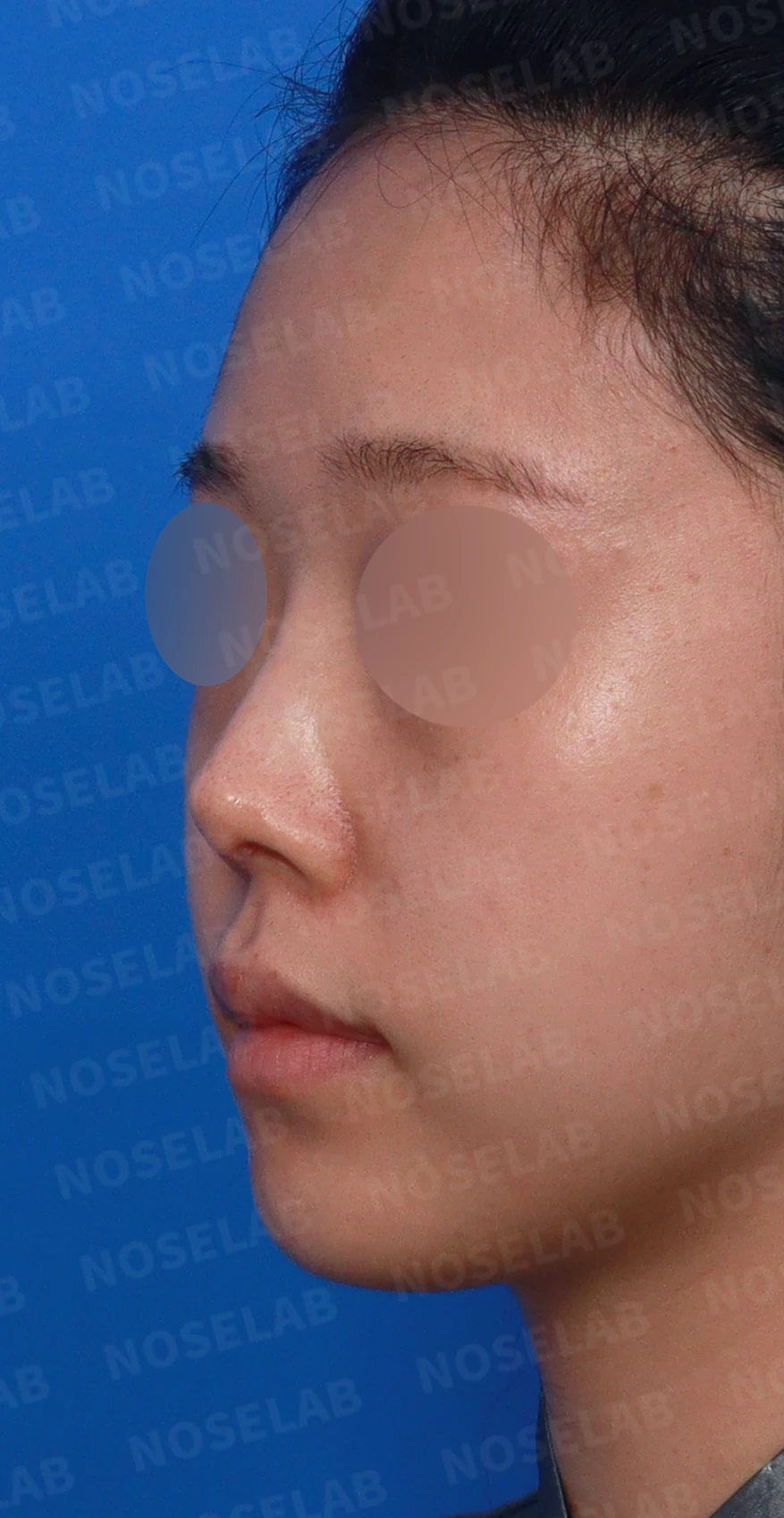 코끝 피부가 얇아져 연골이 비치는 이유, 피부 보강은 어떻게 하나 — 디자인 상담 정면, 좌측 측면, 비스듬한 측면 사진입니다.