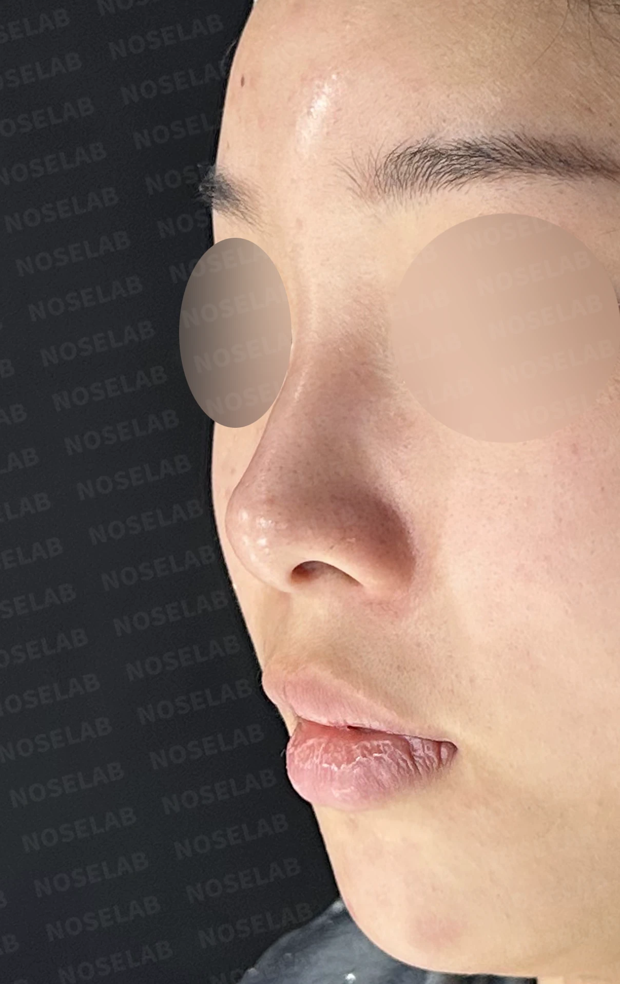 콧대가 넓고 단차져 보이는 이유, 절골술과 늑연골 코끝 성형은 어떻게 하나 — 수술 전 / 수술 직후 0일 직후 사진은 부기가 있는 상태로 최종 결과와 다를 수 있습니다.
